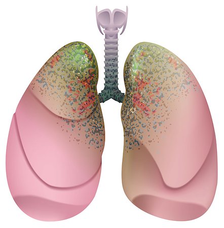 sarcoma - Respiratory system smoker. Lung cancer. Isolated on white vector illustration Stock Photo - Budget Royalty-Free & Subscription, Code: 400-08379540