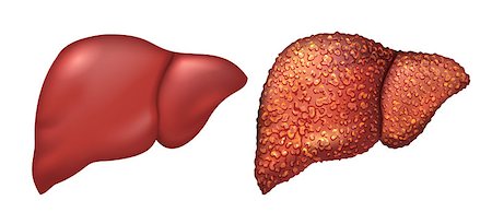 Liver of healthy person. Liver patients with hepatitis. Liver is sick person. Cirrhosis of liver. Repercussion alcoholism. Isolated on white vector illustration Stock Photo - Budget Royalty-Free & Subscription, Code: 400-08379593