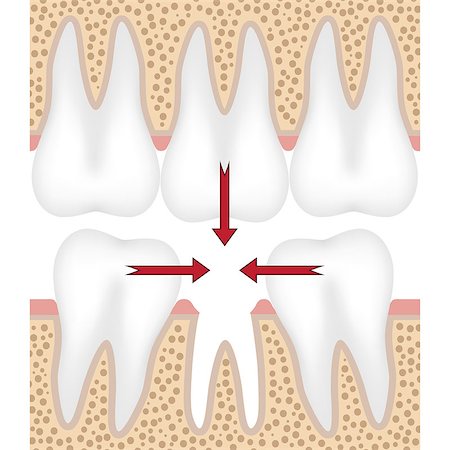 Teeth are moving to fill empty space from missing tooth. Also available as a Vector in Adobe illustrator EPS 8 format. Stock Photo - Budget Royalty-Free & Subscription, Code: 400-08499157