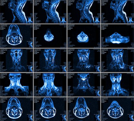 Magnetic resonance imaging of the cervical spine. MRI vertebral discs in different views Stock Photo - Budget Royalty-Free & Subscription, Code: 400-08706135
