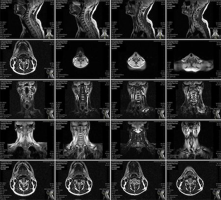 simsearch:400-08294547,k - Magnetic resonance imaging of the cervical spine. MRI vertebral discs in different views Stockbilder - Microstock & Abonnement, Bildnummer: 400-08706138