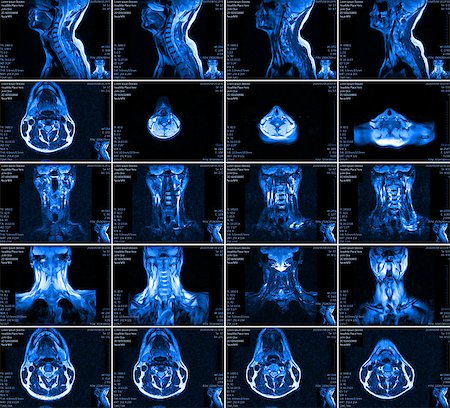 simsearch:400-08294547,k - Magnetic resonance imaging of the cervical spine. MRI vertebral discs in different views Stockbilder - Microstock & Abonnement, Bildnummer: 400-08706139