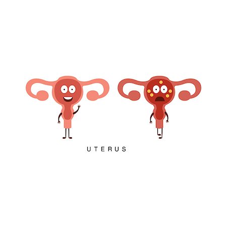 Healthy vs Unhealthy Uterus Infographic Illustration.Humanized Human Organs Childish Cartoon Characters On White Background Stock Photo - Budget Royalty-Free & Subscription, Code: 400-08712112