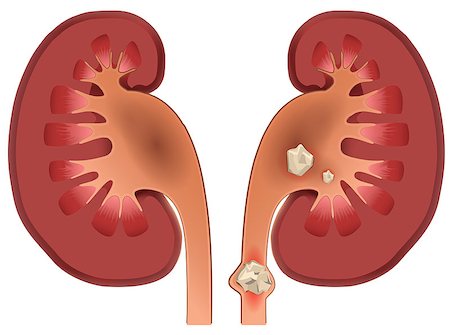 Nephrolithiasis kidney stones disease. Vector medical illustration isolated on white Foto de stock - Royalty-Free Super Valor e Assinatura, Número: 400-08834213