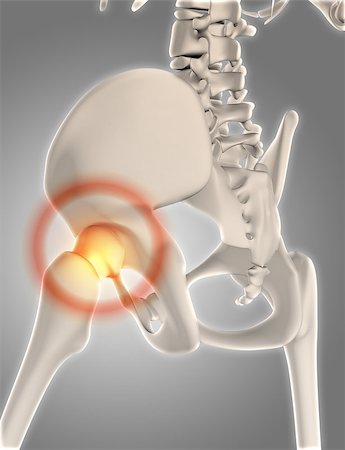 3D render of a skeleton with hip highlighted showing pain Stock Photo - Budget Royalty-Free & Subscription, Code: 400-08899548
