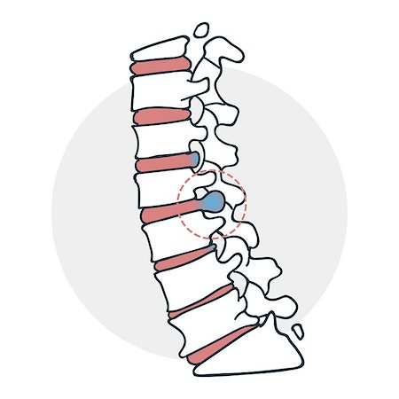 Herniated intervertebral disc icon. Icon on medical subjects. Illustration of a funny cartoon style Stock Photo - Budget Royalty-Free & Subscription, Code: 400-08932335