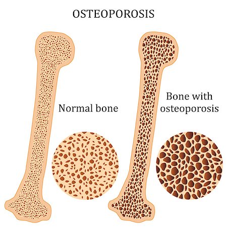 fracture - Illustration of osteoporosis bone and healthy bone. Also available as a Vector in Adobe illustrator EPS 10 format. Stock Photo - Budget Royalty-Free & Subscription, Code: 400-08958570
