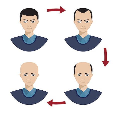 scalp - Information chart showing four stages of hair loss for men. Bolding head from full hair cover to a final stage of baldness. Also available as a Vector in Adobe illustrator EPS 10 format. Stock Photo - Budget Royalty-Free & Subscription, Code: 400-08964931