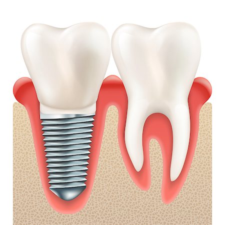 dental technician - Tooth set. Human realistic teeth and Dental implant. And also includes EPS 10 vector Stock Photo - Budget Royalty-Free & Subscription, Code: 400-08998982