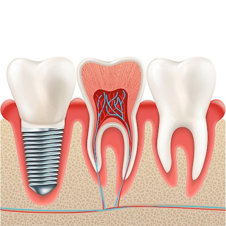 dental technician - Tooth set. Human realistic teeth and Dental implant. And also includes EPS 10 vector Stock Photo - Budget Royalty-Free & Subscription, Code: 400-08999065