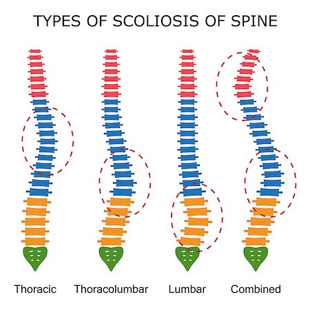 Illustration of types of scoliosis of spine on the white background. Also available as a Vector in Adobe illustrator EPS 10 format. Stock Photo - Budget Royalty-Free & Subscription, Code: 400-08999544