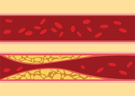 simsearch:400-04189840,k - comparison between normal and unhealthy cholesterol human blood vein cell stream flow with fat on side with flat style illustration vector Foto de stock - Super Valor sin royalties y Suscripción, Código: 400-09112585