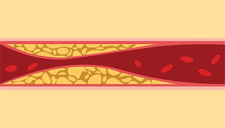 simsearch:400-04189840,k - un healthy cholesterol human blood vein cell stream flow with fat on side with flat style illustration vector Foto de stock - Super Valor sin royalties y Suscripción, Código: 400-09112586