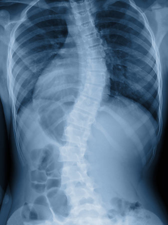 simsearch:400-09000460,k - Scoliosis film x-ray show spinal bend in teenager patient Stock Photo - Budget Royalty-Free & Subscription, Code: 400-09222042
