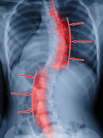 simsearch:400-09000460,k - Scoliosis film x-ray show spinal bend in teenager patient. Treatment concept Stock Photo - Budget Royalty-Free & Subscription, Code: 400-09222043