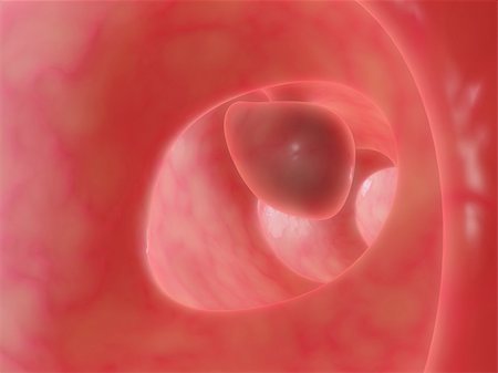 3d rendered anatomy illustration of a big bowel polyp Photographie de stock - Aubaine LD & Abonnement, Code: 400-03954665