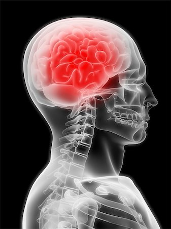 3d rendered x-ray illustration with a painful brain Stock Photo - Budget Royalty-Free & Subscription, Code: 400-03966242