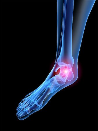 eraxion (artist) - 3d rendered x-ray illustration of a human painful foot Fotografie stock - Microstock e Abbonamento, Codice: 400-03966337