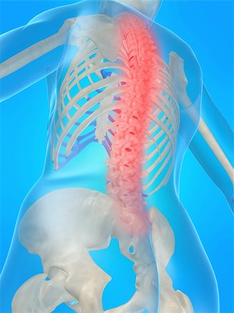 simsearch:400-03966260,k - 3d rendered anatomy illustration of a human skeleton with a painful spine Stockbilder - Microstock & Abonnement, Bildnummer: 400-03966694