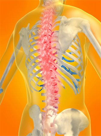 simsearch:400-04008303,k - 3d rendered anatomy illustration of a human skeletal back with pain Stockbilder - Microstock & Abonnement, Bildnummer: 400-03966695