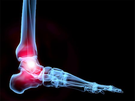 3d rendered x-ray illustration of a human foot with pain Stock Photo - Budget Royalty-Free & Subscription, Code: 400-03962282