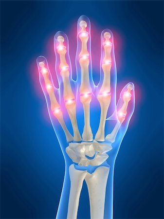 3d rendered anatomy illustration of a human skeletal hand with pain Stock Photo - Budget Royalty-Free & Subscription, Code: 400-03962315