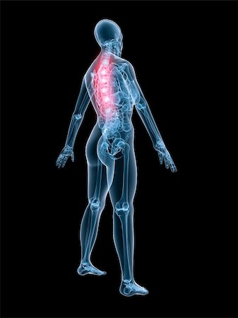 simsearch:400-04008303,k - 3d rendered anatomy illustration of a female skeleton with painful spine Stockbilder - Microstock & Abonnement, Bildnummer: 400-03979555