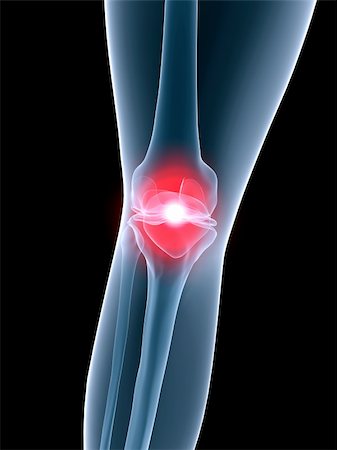 simsearch:400-05311566,k - 3d rendered anatomy illustration of a human knee with pain Stockbilder - Microstock & Abonnement, Bildnummer: 400-03979556