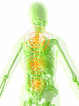 simsearch:400-04008303,k - 3d rendered illustration of a human skeleton with a painful spine Stockbilder - Microstock & Abonnement, Bildnummer: 400-03973351
