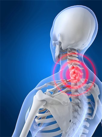 simsearch:400-04008303,k - 3d rendered anatomy illustration of a skeletal neck with pain Stockbilder - Microstock & Abonnement, Bildnummer: 400-03973588