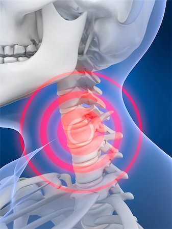 simsearch:400-04163427,k - 3D gerenderten Anatomie Abbildung von einem Skelett Hals mit Schmerzen Stockbilder - Microstock & Abonnement, Bildnummer: 400-03973581