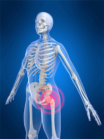simsearch:400-04163427,k - 3d rendered anatomy illustration of a female skeleton with a painful hip Stockbilder - Microstock & Abonnement, Bildnummer: 400-03973582