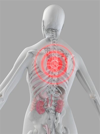 simsearch:400-04008303,k - 3d rendered illustration of a human skeleton with a painful spine Stockbilder - Microstock & Abonnement, Bildnummer: 400-03973813