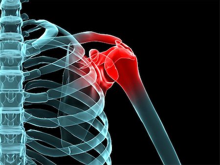 3d rendered x-ray illustration of a human shoulder with pain Stock Photo - Budget Royalty-Free & Subscription, Code: 400-03993656