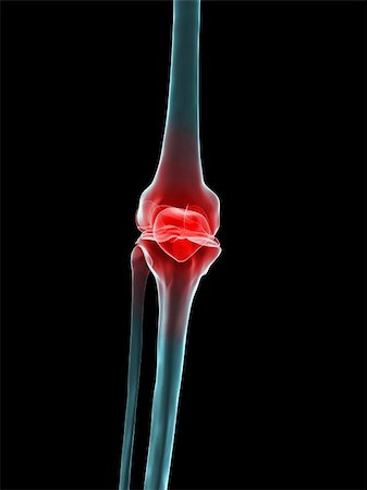 simsearch:400-05311566,k - 3d rendered x-ray illustration of a human knee with pain Stockbilder - Microstock & Abonnement, Bildnummer: 400-03993662