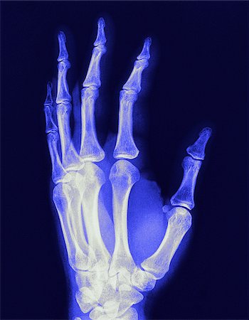 X-Ray of Hand Stock Photo - Premium Royalty-Free, Code: 600-00058090