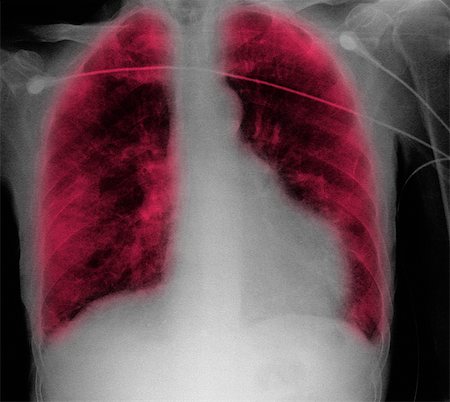 CXR of old man, congestive heart failure, anemia Foto de stock - Sin royalties Premium, Código: 614-08870022