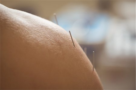 simsearch:6109-08829749,k - Close-up of a patient getting dry needling Stock Photo - Premium Royalty-Free, Code: 6109-08829740