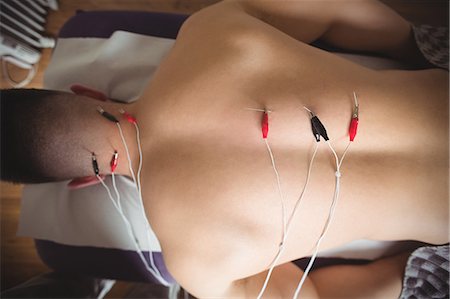 skin treatment medical - Patient getting electro dry needling on his back Foto de stock - Sin royalties Premium, Código: 6109-08829802