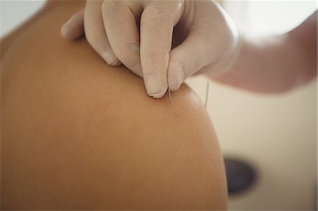 simsearch:6109-08829783,k - Close-up of physiotherapist performing dry needling on patient Stockbilder - Premium RF Lizenzfrei, Bildnummer: 6109-08829828