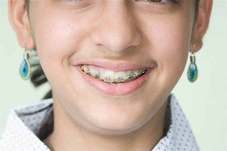 simsearch:630-02219279,k - Close-up of a girl wearing braces Foto de stock - Royalty Free Premium, Número: 630-02219281