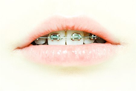 Teenage girl's mouth with braces, extreme close-up Foto de stock - Sin royalties Premium, Código: 632-01276864