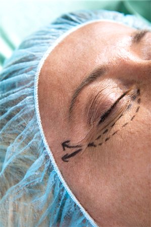 Close up of patient's face with incision lines Stock Photo - Premium Royalty-Free, Code: 644-03659500