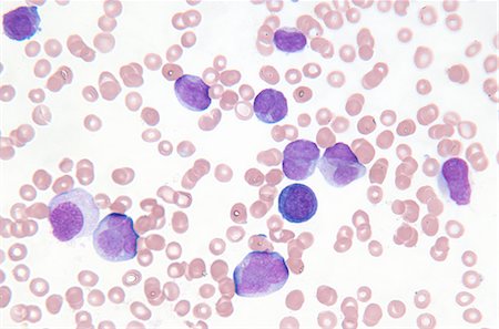 sangue - Close up of myelogenous leukemia cells Fotografie stock - Premium Royalty-Free, Codice: 649-05801918