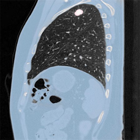 Chest CT scan (X-ray computed tomography) of a male 54 year old patient. A tumour can be seen in the left upper lobe of his lungs Stock Photo - Premium Royalty-Free, Code: 649-06829945