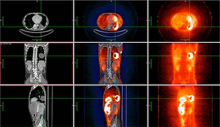 poumons - Image from co-registered PET-CT study from dual modality scanner. Patient with multiple metastatic lesions in liver & lung. PET data superimposed over CT scan axial slice through lung metastases Photographie de stock - Premium Libres de Droits, Code: 649-08144218