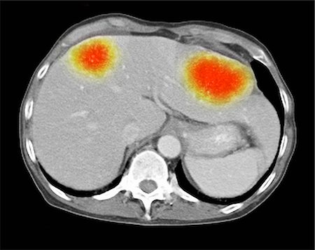 Image from a co-registered PET-CT study from dual modality scanner. Patient with multiple metastatic lesions in liver & lung. PET data superimposed over CT scan axial slice through liver metastases Stock Photo - Premium Royalty-Free, Code: 649-08144219