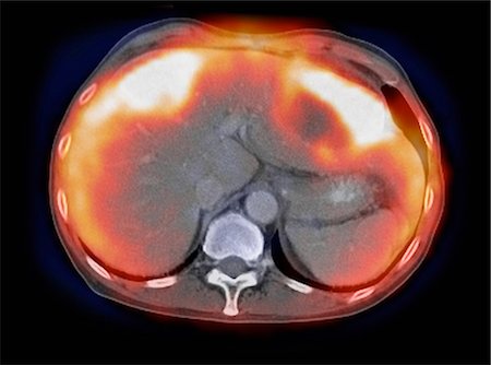 disease - Image from a co-registered PET-CT study from dual modality scanner. Patient with multiple metastatic lesions in liver & lung. PET data superimposed over CT scan axial slice through liver metastases Stock Photo - Premium Royalty-Free, Code: 649-08144220
