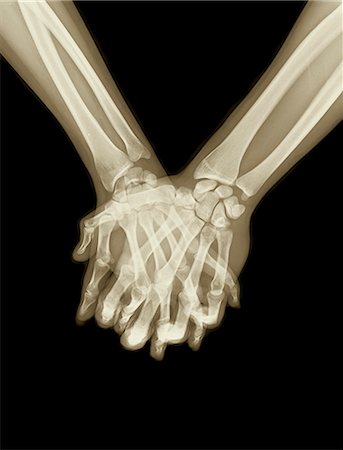 Xray image of hands and fingers clasped Stock Photo - Premium Royalty-Free, Code: 649-08565770