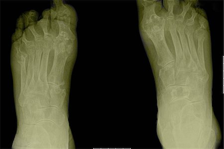 rheumatoid arthritis - X-ray showing arthritic feet Stock Photo - Premium Royalty-Free, Code: 649-09003000